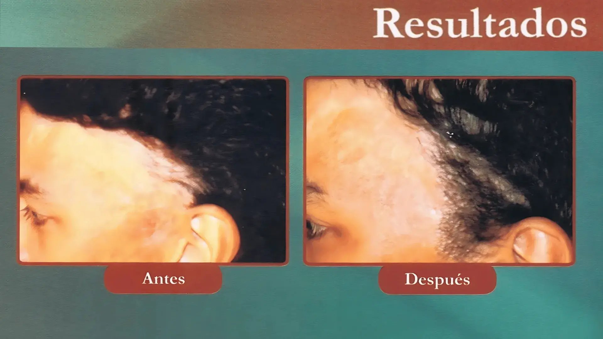 antes-despues-trasplante-capilar-8