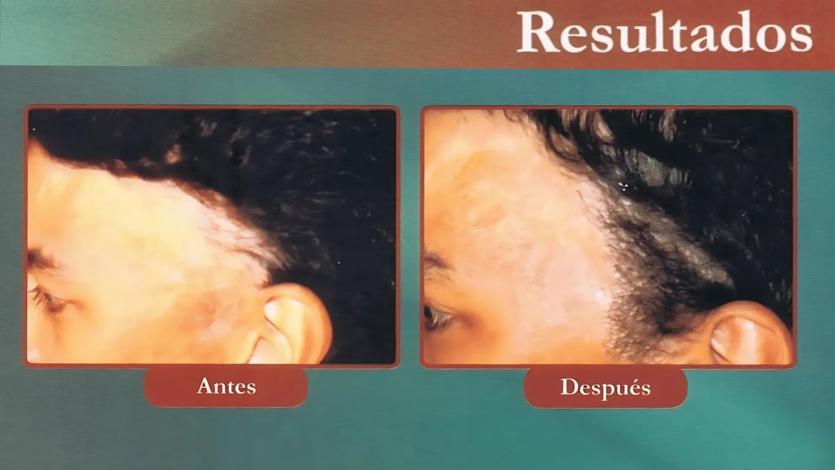 antes-despues-trasplante-capilar-8