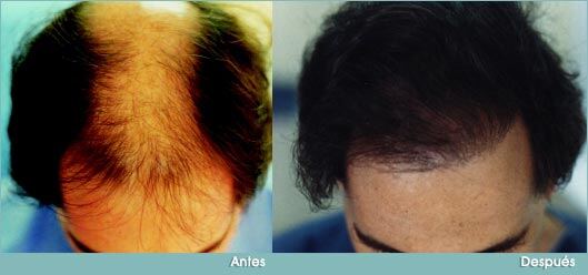 trasplante-capilar-1