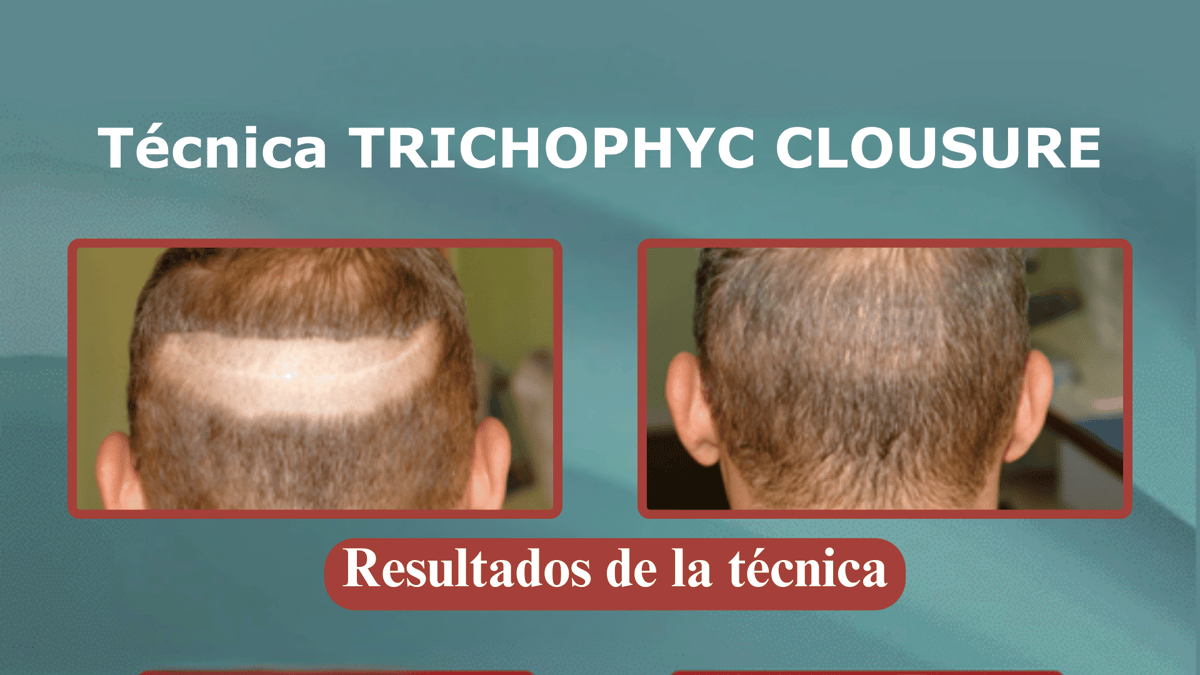 resultados-técnica-Trichophytic Closure